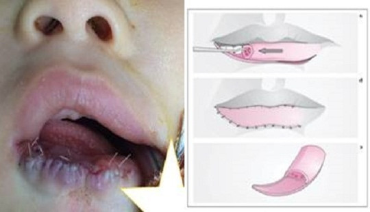 Phẫu thuật thành công khối dị dạng mạch máu vùng môi cho bé trai 7 tháng tuổi