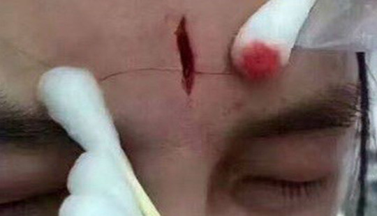 Y tá viện nhi bị đánh rách trán vì tiêm lệch ven bệnh nhân 3 tuổi