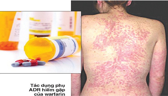 27 trường hợp tử vong vì phản ứng có hại của thuốc