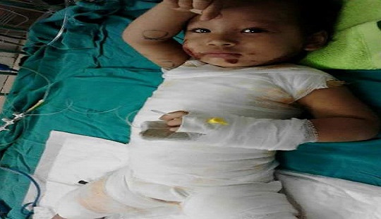 Mẹ đi vệ sinh, bé gái 2 tuổi bị cả nồi canh đang sôi đổ lên người