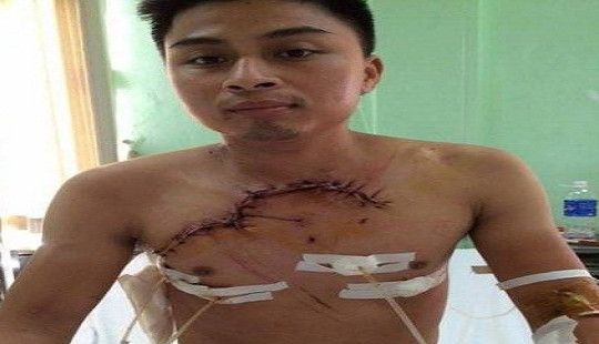 Cứu sống nam bệnh nhân bị chấn thương ngực lộ tim phổi