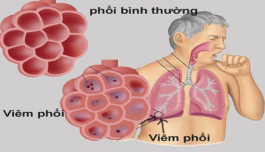 Bệnh viêm phổi có triệu chứng như thế nào?