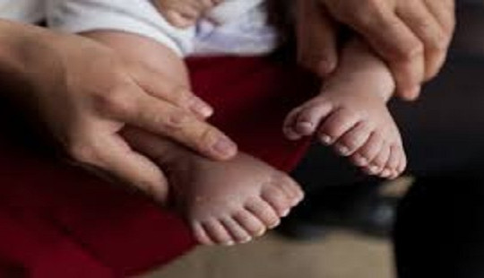 Tiến hành phẫu thuật cho em bé có 31 ngón tay và chân