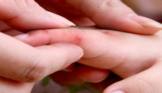 Cách nhận biết và chăm sóc trẻ mắc bệnh Tay - Chân - Miệng