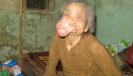 Chuyện tình đẫm nước mắt của người đàn bà "mặt quỷ”
