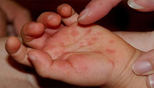 Bộ Y tế khuyến cáo phòng bệnh tay-chân-miệng