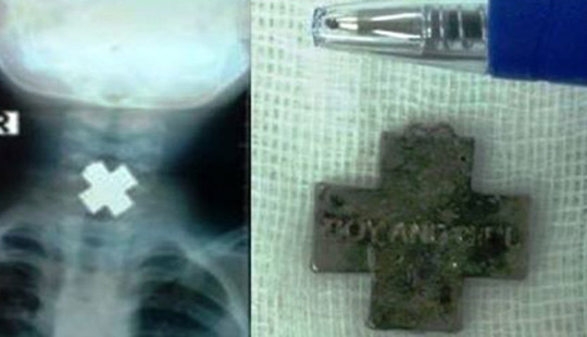 Bé trai 3 tuổi nguy kịch vì nuốt mảnh kim loại hình chữ thập