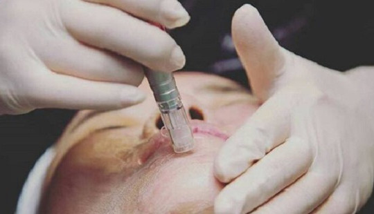 Cấy phấn vào da: Coi chừng mất mạng