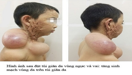 Phẫu thuật điều trị sẹo lồi khổng lồ vùng hàm mặt sau bỏng cồn cho bé trai 9 tuổi