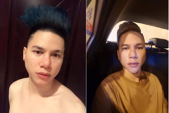 Hoàng Tôn bị biến dạng khuôn mặt vì "lỗi dao kéo'