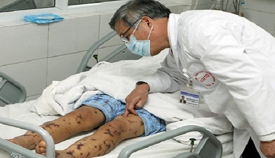 Hà Nội khống chế ổ dịch viêm não mô cầu