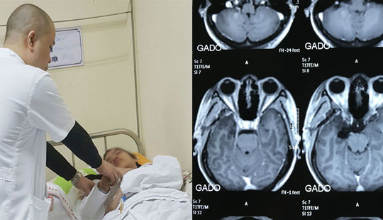 Phẫu thuật điều trị động kinh: "Phép màu" tái sinh cho người bệnh