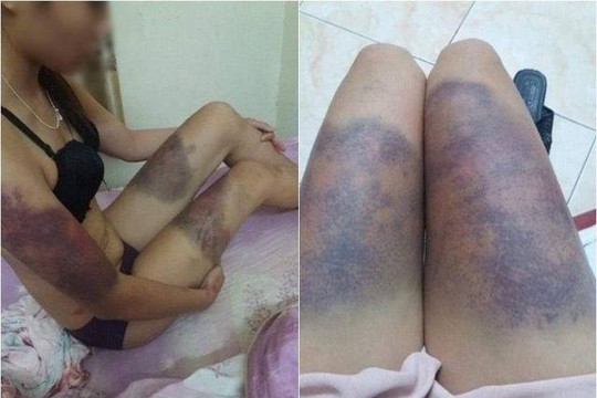 Kẻ hành hung bạn gái thâm tím khắp người từng phạm tội giết người