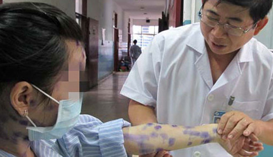 Bộ Y tế khuyến cáo các biện pháp phòng tránh bệnh thủy đậu