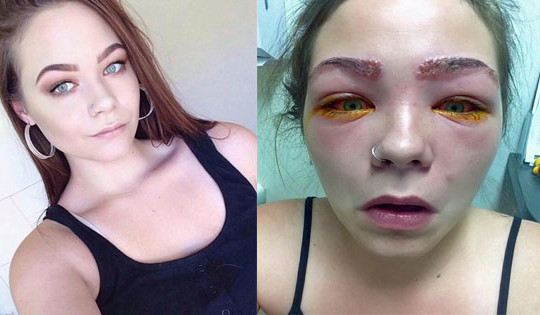 Cô gái 16 tuổi suýt mù mắt vì nhuộm lông mày