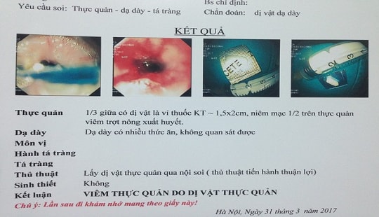 Hóc dị vật thực quản vì... uống thuốc