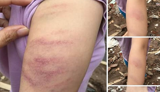 Làm thiếu bài tập, học sinh bị cô giáo đánh bầm tím tay