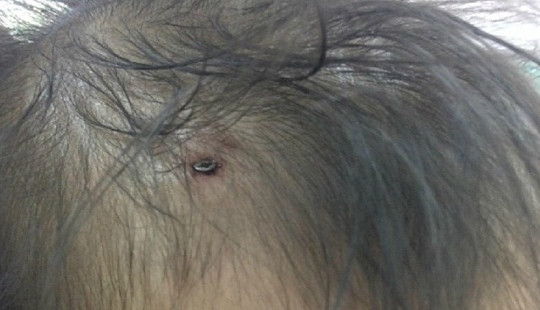 Bé 19 tháng tuổi bị đinh cắm vào đầu khi chơi cùng bạn