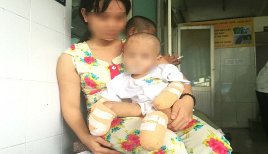 Bé 2 tuổi phải cắt tứ chi vì viêm não mô cầu