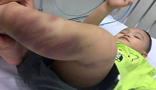 Bé 1 tuổi nhập viện với nhiều vết thương nghi do bạo hành