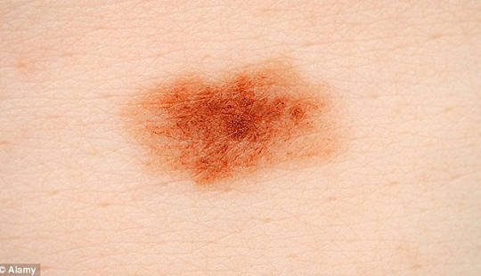 Liệu pháp vitamin giúp ngăn ngừa ung thư da