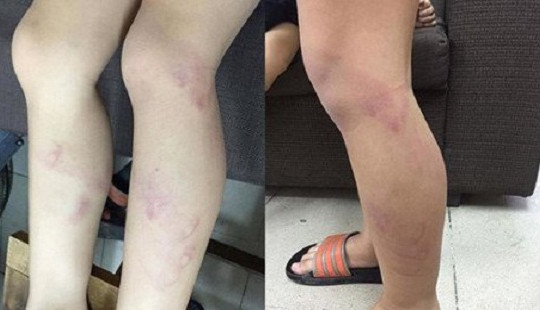 Hà Nội: Tạm đình chỉ cô giáo đánh trẻ lớp 2 tím chân