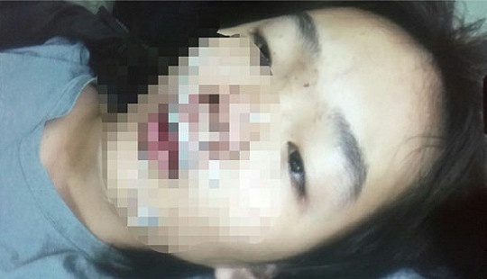 Dùng 5 mét chỉ khâu vết thương của bé 11 tuổi ngã vào cửa kính
