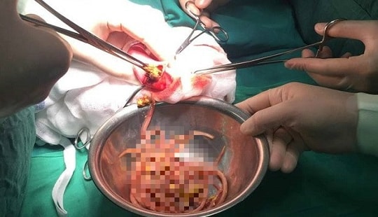 Hoảng hồn phát hiện búi giun đũa gây tắc ruột bé 3 tuổi