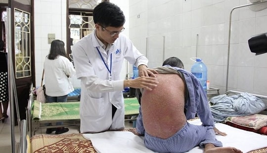 Suy thận, bong da vì tự ý chữa vảy nến bằng thuốc không rõ nguồn gốc