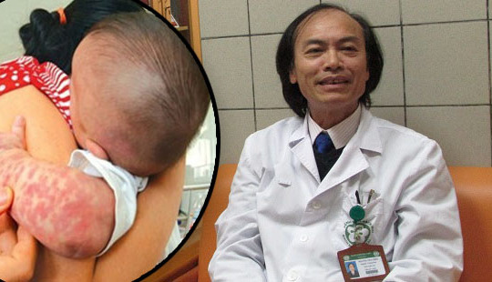 Bệnh sởi gia tăng: Bác sĩ chỉ cách phân biệt sởi và sốt phát ban