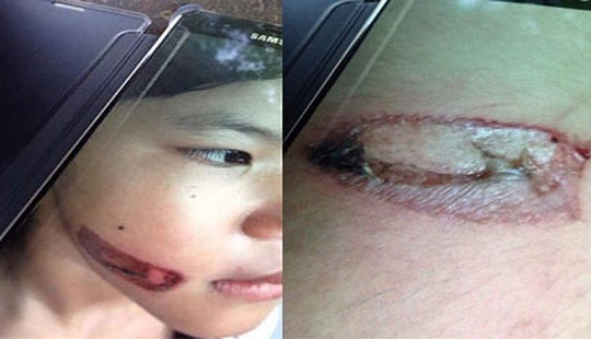 Bé gái bị cha ruột và mẹ kế bạo hành bằng sắt nung đỏ