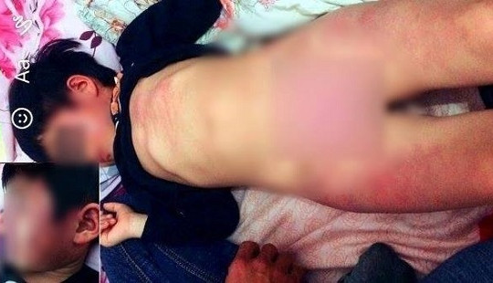 Kỷ luật hiệu trưởng và giáo viên để trẻ bị đánh bầm tím khắp người