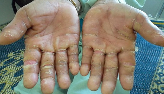 Quảng Ngãi: Hội chứng viêm da dày sừng tái phát sau 3 năm tạm lắng