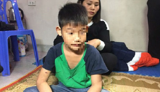Bé trai bị bạo hành ở Đông Anh: Bố mẹ ký đơn hòa giải