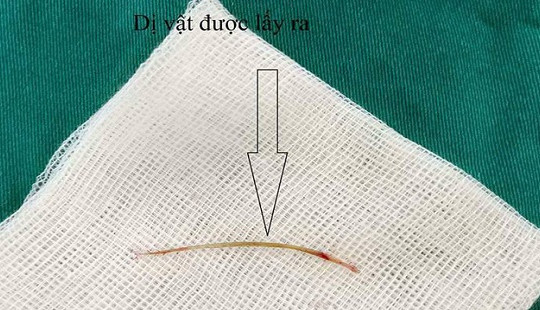 Thủng ruột chỉ vì... hóc xương cá