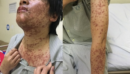Tự ý dùng thuốc kháng sinh, cô gái trẻ biến dạng khuôn mặt vì dị ứng