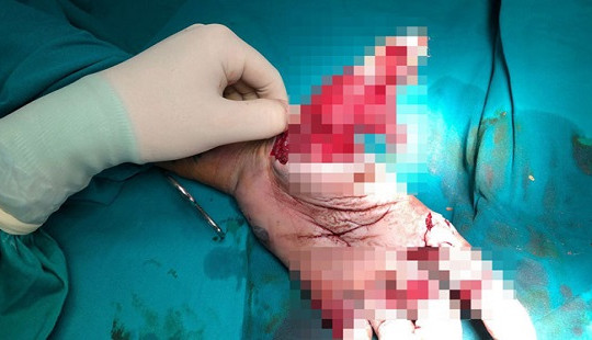 Đốt pháo tết, nam thanh niên bị dập nát bàn tay