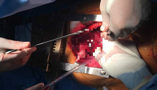 Ho ra máu mới phát hiện mang khối u lớn trong ngực