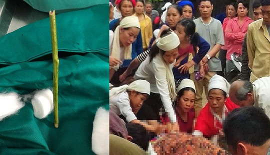 Sản phụ tử vong vì phá thai bằng que nứa: Bộ Y tế vào cuộc
