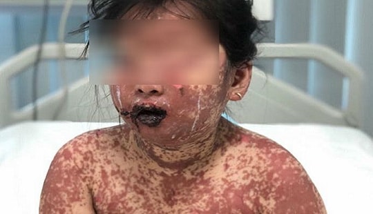 Dị ứng thuốc, bé 7 tuổi bị bỏng toàn thân