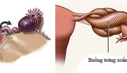 Bé gái 10 tuổi suýt mất buồng trứng vì khối u