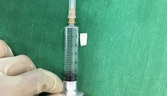 Cùi dừa găm vào thanh quản, bé 12 tháng tuổi nguy kịch