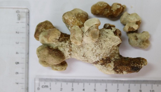 Hiếm gặp: Cụ ông 71 tuổi mang 'san hô biển' trong thận