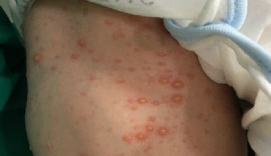 Mẹ mang bầu không tiêm xắc xin, bé 10 ngày tuổi "dính" thủy đậu
