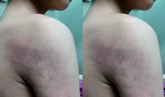 Hà Nội: Học sinh lớp 1 bầm tím cánh tay sau khi bị cô giáo đánh