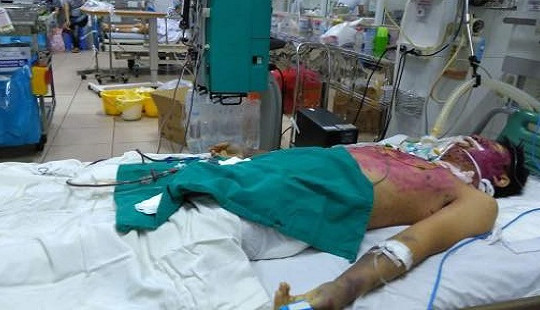 Sơn La: Một bệnh nhân mắc thủy đậu biến chứng nguy kịch