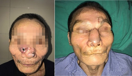 Mắc ung thư da, người đàn ông bị khoét sạch mũi, má
