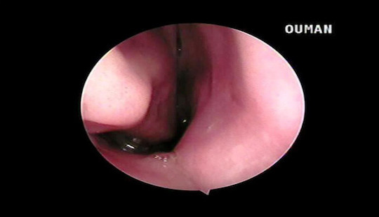 Tá hoả phát hiện con vắt 7cm ký sinh trong mũi bà cụ