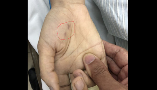 Chủ quan không tiêm phòng dại khi chó cắn, bác sĩ thú y tử vong