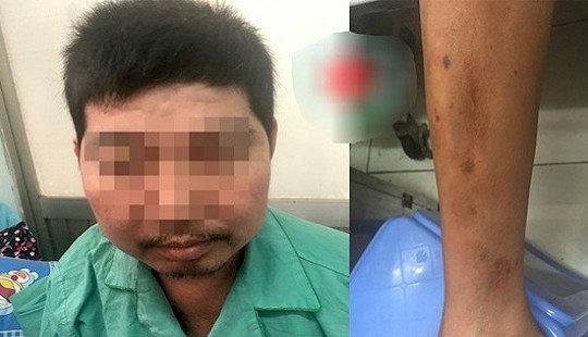 Sưng mặt, biến dạng chân vì đắp thuốc không rõ nguồn gốc